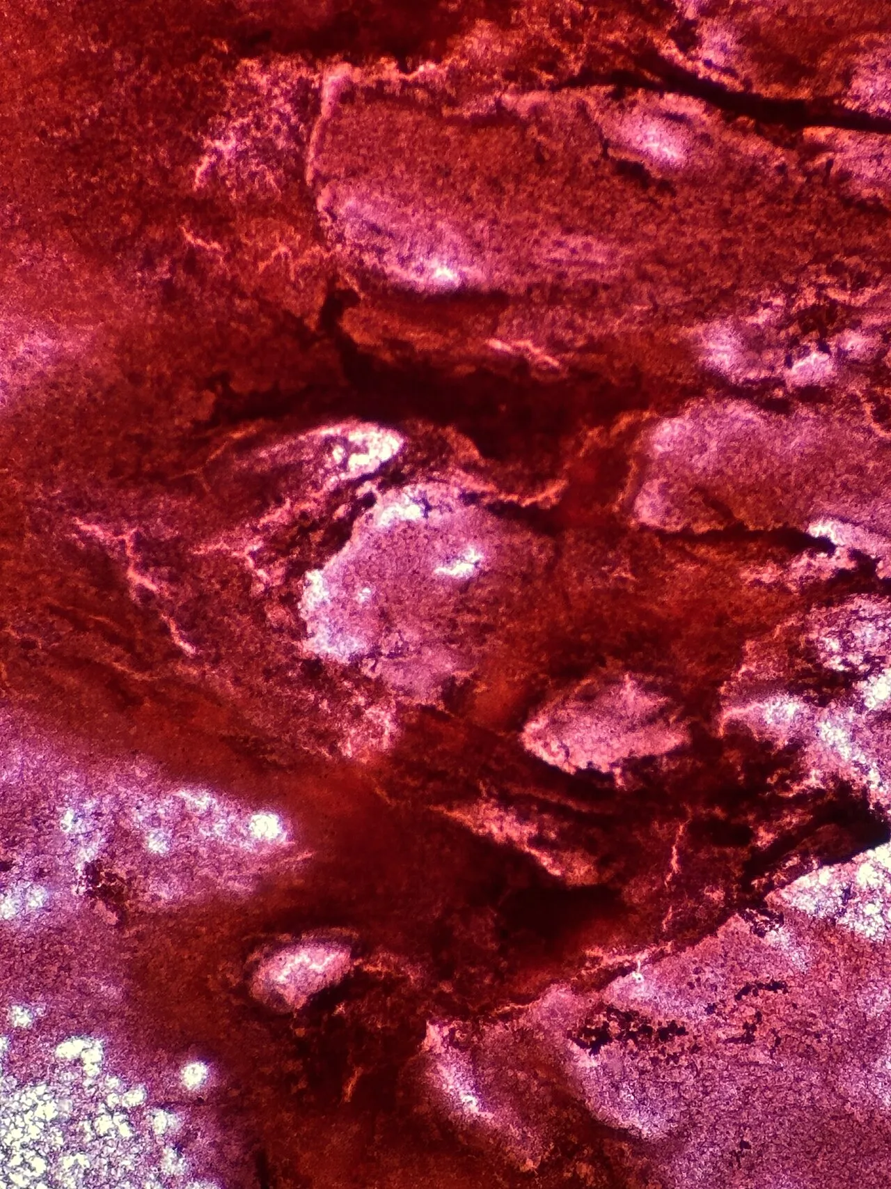 File:Blood seen on Pap smear from thyroid cyst, portrait format.jpg
