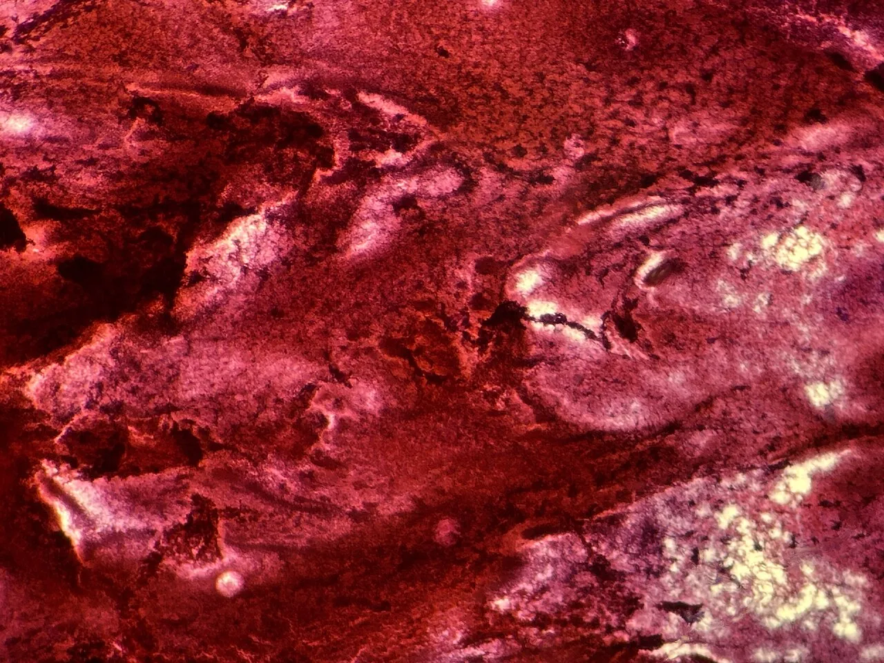 File:Blood seen on Pap smear from thyroid cyst, horizontal format.jpg