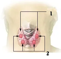 thyroid cancer (Wikidata P18)