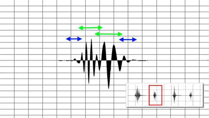 Second heart sound 110bpm