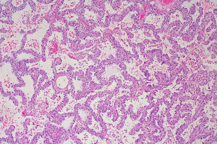 Lung adenocarcinoma with lepidic growth - low magnification