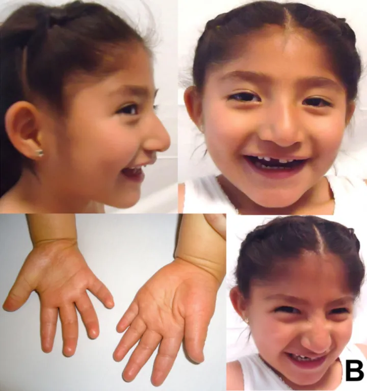 5-year-old Mexican girl with Angelman syndrome (cropped)