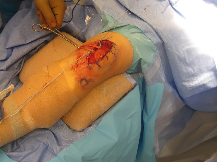 My knee surgery (5101085634)