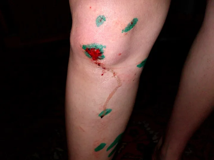 Brilliant green (зелёнка) on a knee injury (2012-07-04)