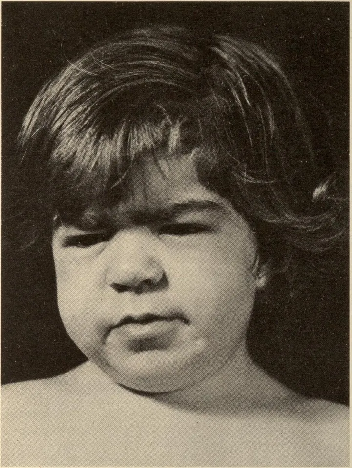 Mucopolysaccharidosis (Sanfilippo Syndrome) 1