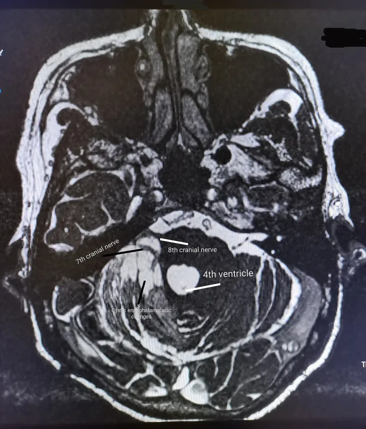 T2 weighted axial section of MRI brain showing cystic encephalomyelitic changes of right cerebellum