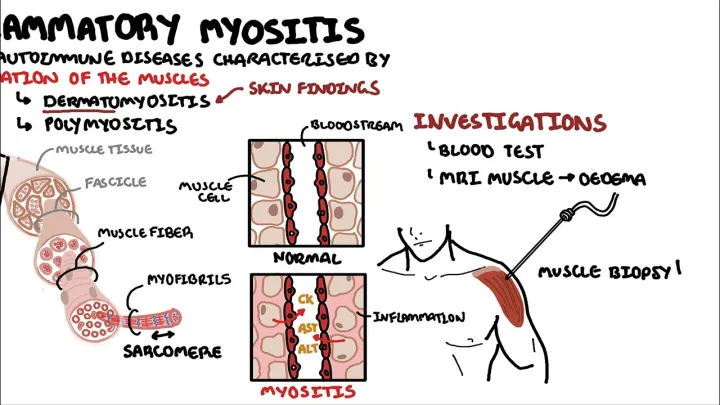 Understanding Inflammatory Myopathies - Dermatomyositis, Polymyositis, Antisynthetase syndrome