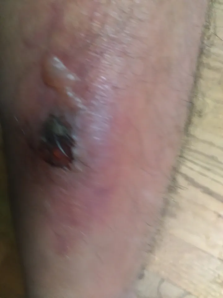Wound in skin caused by boils in skin (deep skin bacterial infections) 2024 04