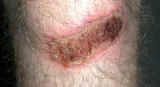 Scab (knee)