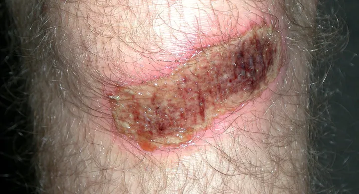 Scab (knee)