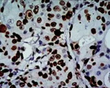 Positive immunohistochemistry of KI-67 in invasive breast cancer