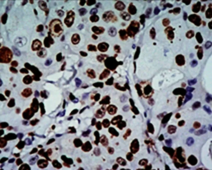 Positive immunohistochemistry of KI-67 in invasive breast cancer