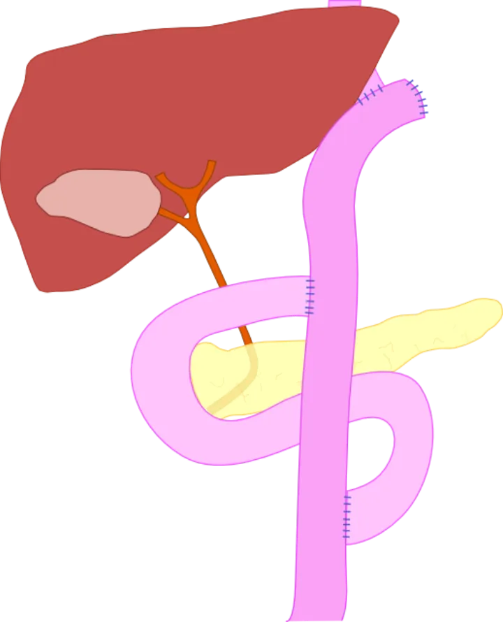 Total gastrectomy with Double tract