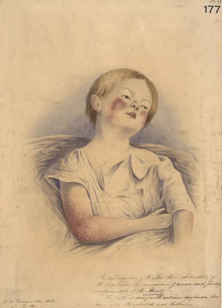 Child with congestion of the skin caused by heart disease Wellcome L0061129